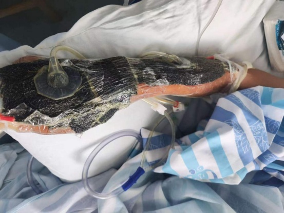 提醒:戴手套!戴手套!佛山一女士疏忽小伤口,导致躺在ICU生死博弈一个月! 提醒:戴手套!戴手套!佛山一女士疏忽小伤口,导致躺在ICU生死博弈一个月!