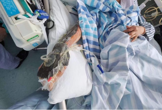 提醒:戴手套!戴手套!佛山一女士疏忽小伤口,导致躺在ICU生死博弈一个月! 提醒:戴手套!戴手套!佛山一女士疏忽小伤口,导致躺在ICU生死博弈一个月!