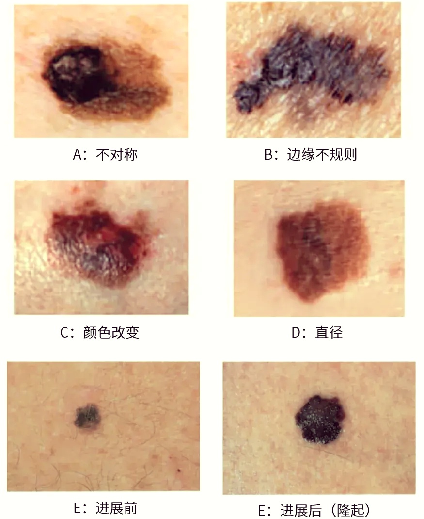 鼻子上长了个“小疙瘩”,不痛不痒没在意,一查竟是癌前病变 鼻子上长了个“小疙瘩”,不痛不痒没在意,一查竟是癌前病变