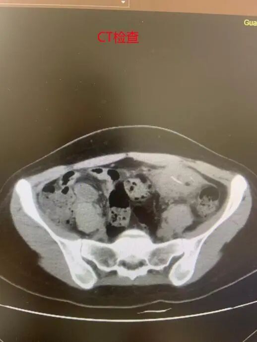 女子边吃饭边刷手机,无意中吞下一次性筷子的竹片…接下来的发展让人后怕 女子边吃饭边刷手机,无意中吞下一次性筷子的竹片…接下来的发展让人后怕