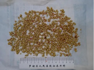 密密麻麻，男子膀胱取出超1200颗结石，医生：或与饮水少、就医晚有关