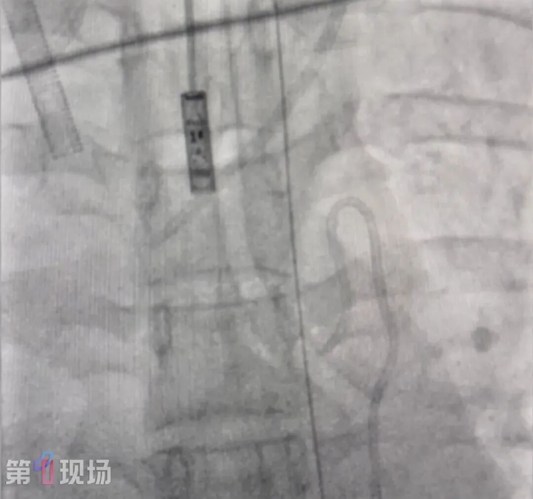 21岁女子漂流呛水后吐血不止!一查肺部竟有个“定时炸弹”!ECMO+手术抢回一命 21岁女子漂流呛水后吐血不止!一查肺部竟有个“定时炸弹”!ECMO+手术抢回一命