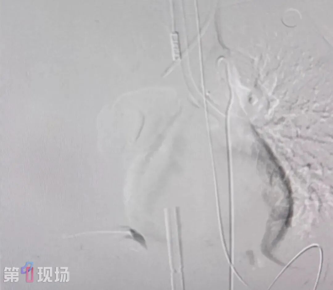21岁女子漂流呛水后吐血不止!一查肺部竟有个“定时炸弹”!ECMO+手术抢回一命 21岁女子漂流呛水后吐血不止!一查肺部竟有个“定时炸弹”!ECMO+手术抢回一命