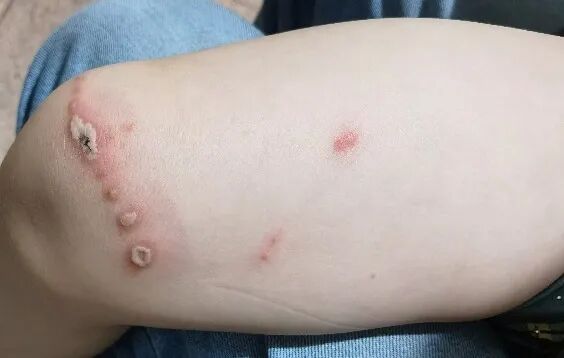 不要拍!不要打!正是隐翅虫高峰期,杭州姑娘痛到失眠,还有人差点毁容 不要拍!不要打!正是隐翅虫高峰期,杭州姑娘痛到失眠,还有人差点毁容