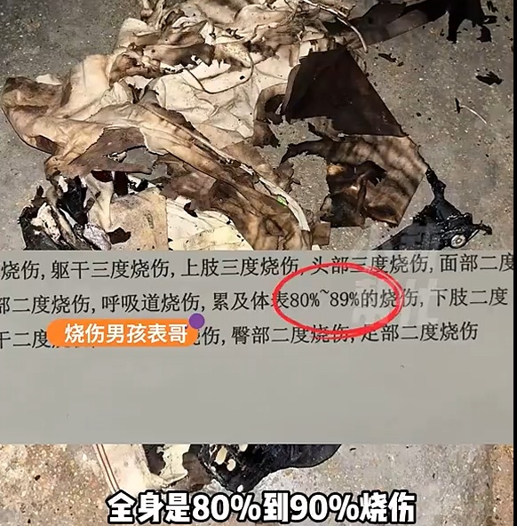 12岁男孩全身90%烧伤!一根铁丝酿剧,赶紧自查家中这个隐患 12岁男孩全身90%烧伤!一根铁丝酿剧,赶紧自查家中这个隐患