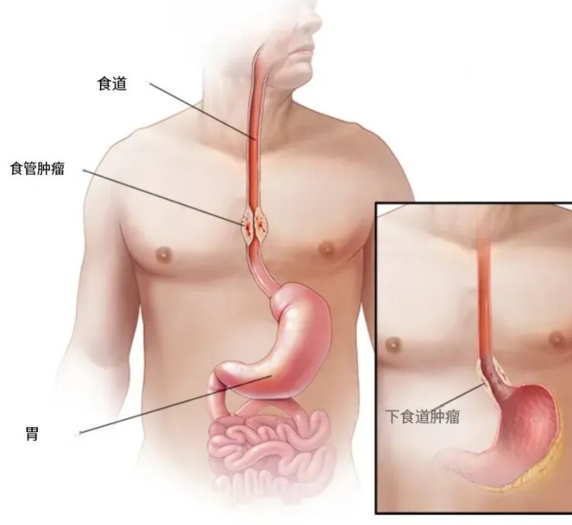 立即停止!这个吃饭习惯会致癌,很多人还以为很养生 立即停止!这个吃饭习惯会致癌,很多人还以为很养生