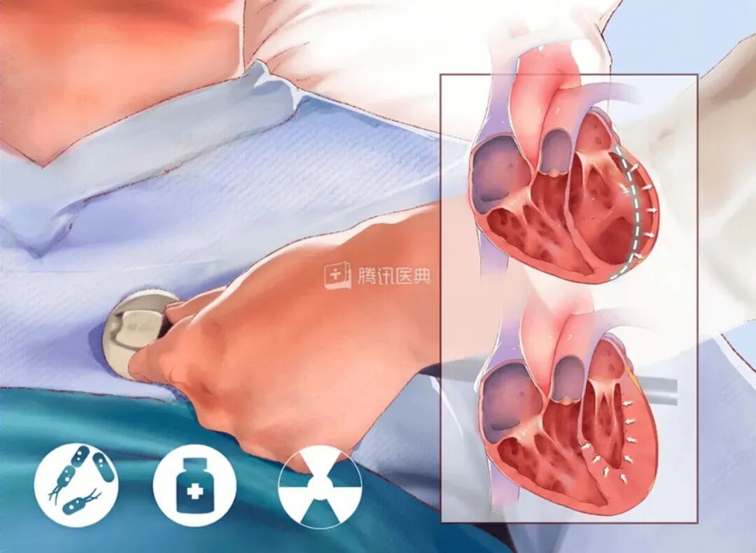 高烧40℃以为只是感冒，男子患暴发性心肌炎心脏差点“停工”