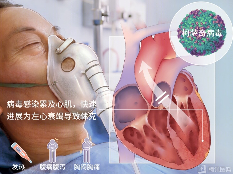高烧40℃以为只是感冒，男子患暴发性心肌炎心脏差点“停工”