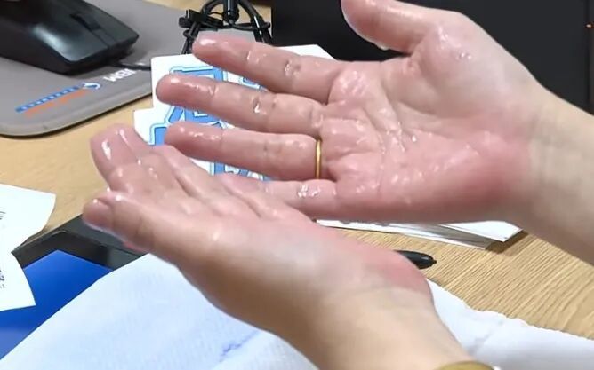 掌心“暴雨”下了十几年,台州女子和爱人牵手都躲开;医生在她腋下开了个小孔…… 掌心“暴雨”下了十几年,台州女子和爱人牵手都躲开;医生在她腋下开了个小孔……
