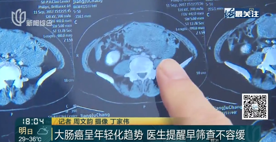 不喝泻药能做肠镜?全国仅上海这家医院有!免费!医生亲测:很爽 不喝泻药能做肠镜?全国仅上海这家医院有!免费!医生亲测:很爽