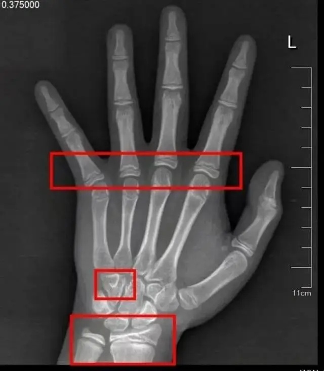 9岁女孩确诊性早熟,“催熟”元凶藏在日常里!医生提醒:这些信号必须注意 9岁女孩确诊性早熟,“催熟”元凶藏在日常里!医生提醒:这些信号必须注意