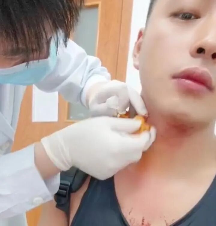 男子被蚊子叮咬颈部 抓挠后血流不止 当事人发声:朋友都以为我跟人打架了 男子被蚊子叮咬颈部 抓挠后血流不止 当事人发声:朋友都以为我跟人打架了