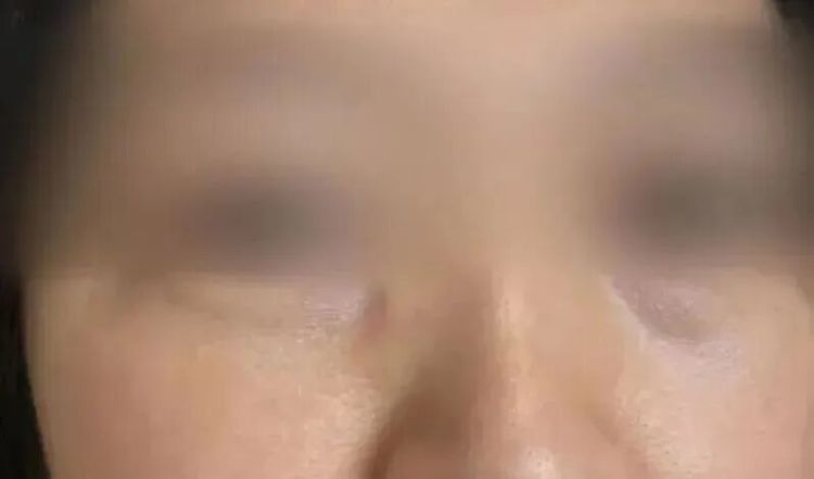 一颗长了十几年的痣,竟是癌!痣的5个危险信号,照镜子自查 一颗长了十几年的痣,竟是癌!痣的5个危险信号,照镜子自查