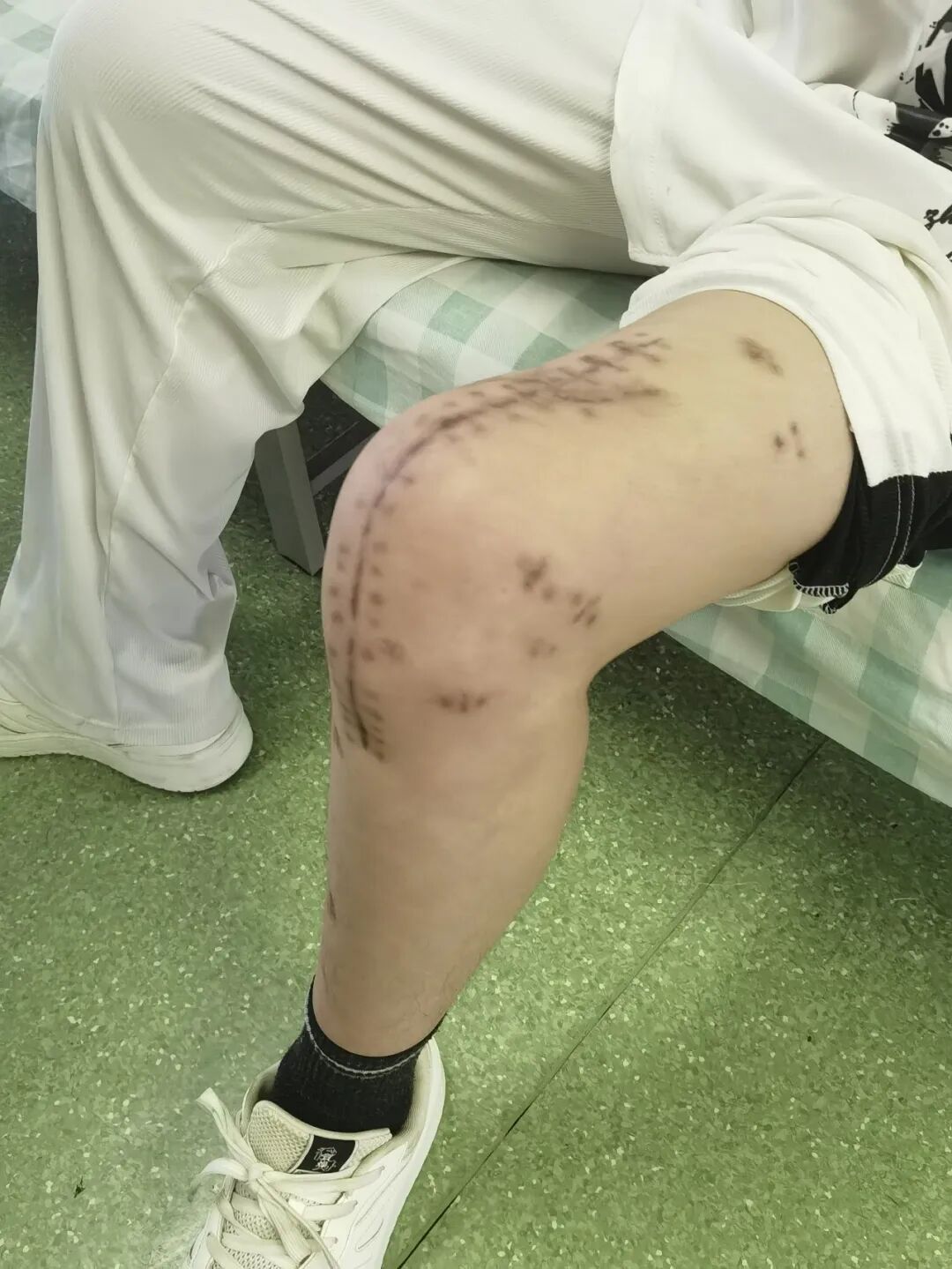 27岁,股骨碎成数十块,医生一块块拼了回去 27岁,股骨碎成数十块,医生一块块拼了回去