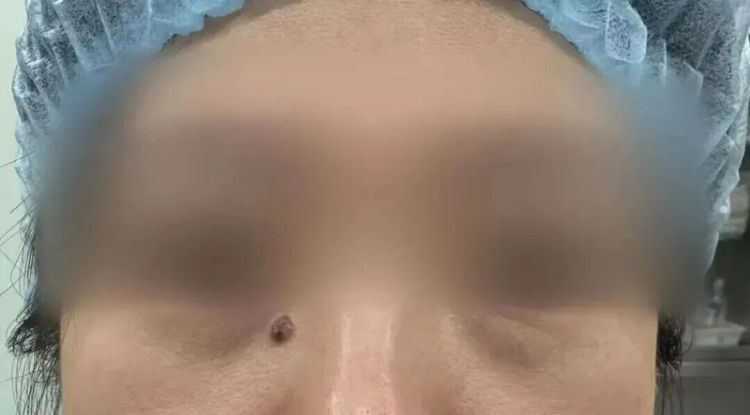 一颗长了十几年的痣,竟是癌!痣的5个危险信号,照镜子自查 一颗长了十几年的痣,竟是癌!痣的5个危险信号,照镜子自查