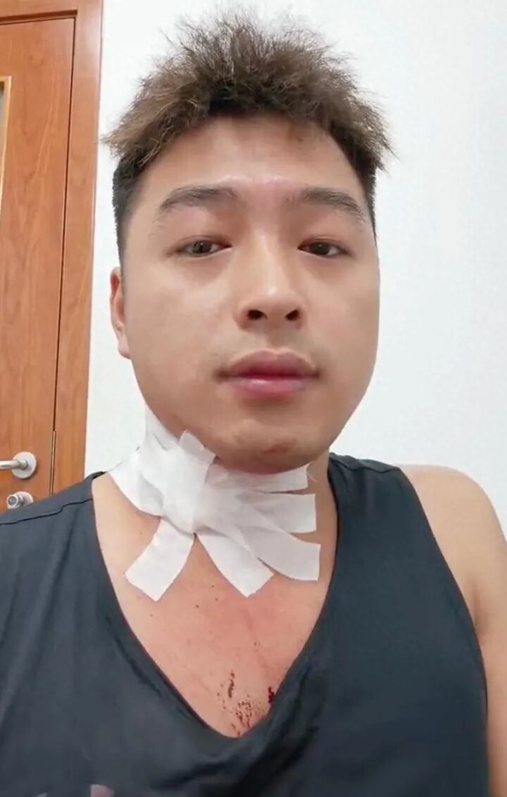 男子被蚊子叮咬颈部 抓挠后血流不止 当事人发声:朋友都以为我跟人打架了 男子被蚊子叮咬颈部 抓挠后血流不止 当事人发声:朋友都以为我跟人打架了