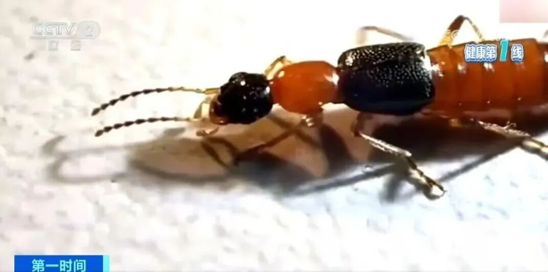 眼下正是活跃期!碰到隐翅虫不要拍、不要打,有人被咬痛到失眠 眼下正是活跃期!碰到隐翅虫不要拍、不要打,有人被咬痛到失眠