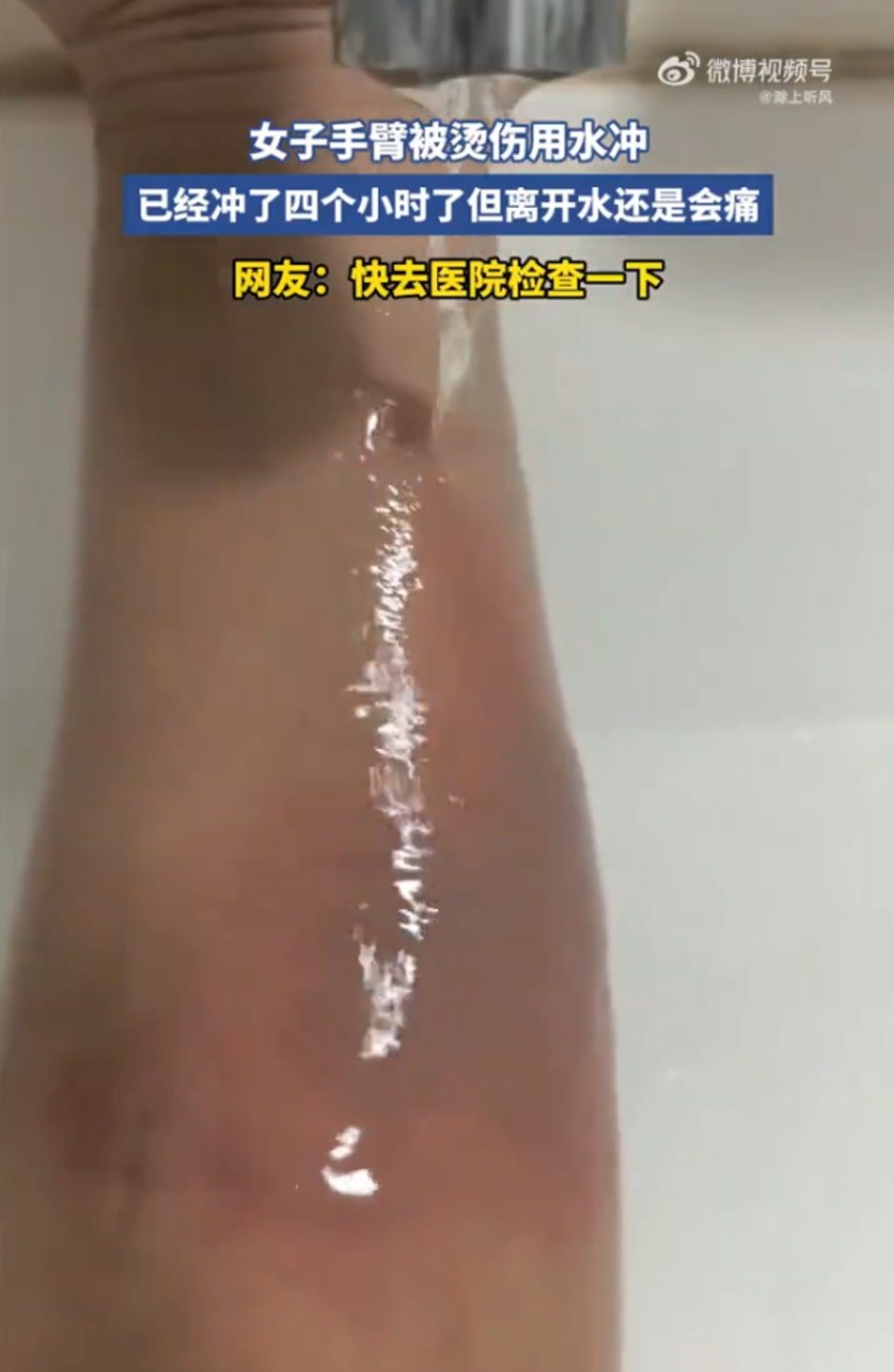 冲了20年冷水，你今天告诉我这是错的？烫伤急救，我们都被骗了