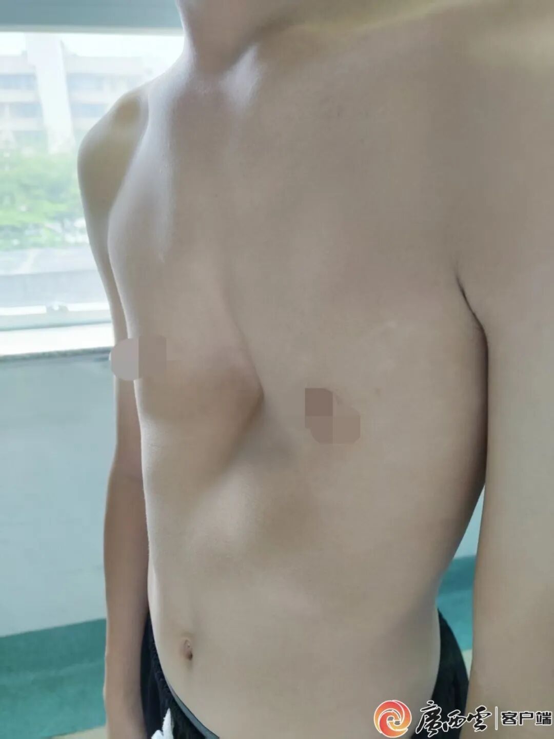孩子胸口凹陷别忽视!这些后果家长意想不到…… 孩子胸口凹陷别忽视!这些后果家长意想不到……