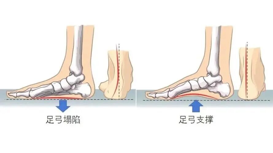 6种可能很伤脚的“网红鞋”,很多人天天穿 6种可能很伤脚的“网红鞋”,很多人天天穿