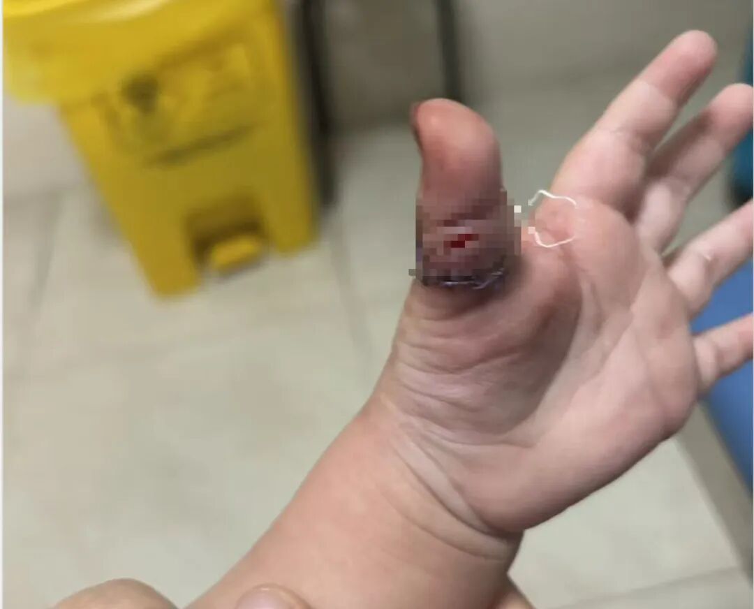 郑州两岁女童景区喂兔子被咬伤手指,景区以有提醒牌为由拒赔,法院判了 郑州两岁女童景区喂兔子被咬伤手指,景区以有提醒牌为由拒赔,法院判了
