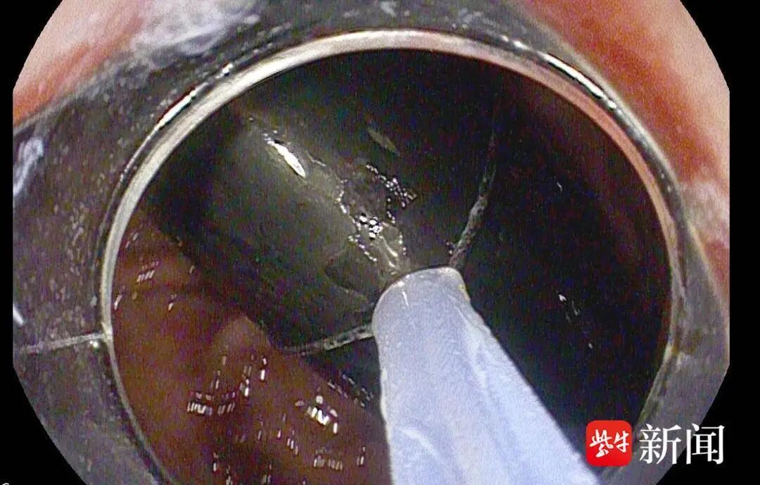 男子误吞打火机，7年后才被取出！医生：已被腐蚀，随时可能泄漏