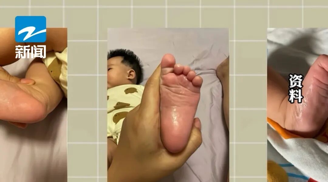 一个不起眼的动作，女子脸部过敏！皮肤科医生紧急提醒