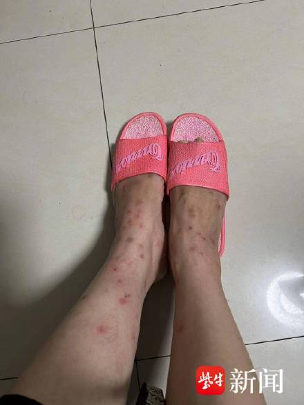 女子小区散步一圈腿上密布小点点 女子小区散步一圈腿上密布小点点