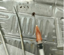 头皮突现黑色小虫,家长徒手一拔,结果进了医院 头皮突现黑色小虫,家长徒手一拔,结果进了医院