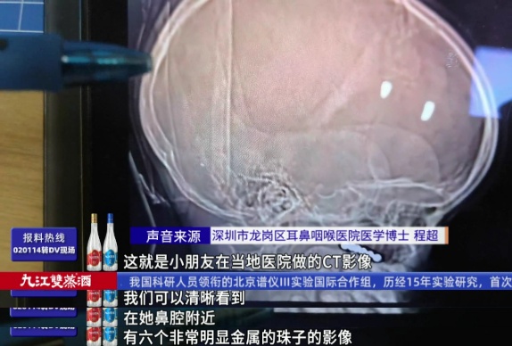 6岁女孩总爱“咬嘴唇”,鼻腔里竟然藏了6颗磁力珠 6岁女孩总爱“咬嘴唇”,鼻腔里竟然藏了6颗磁力珠