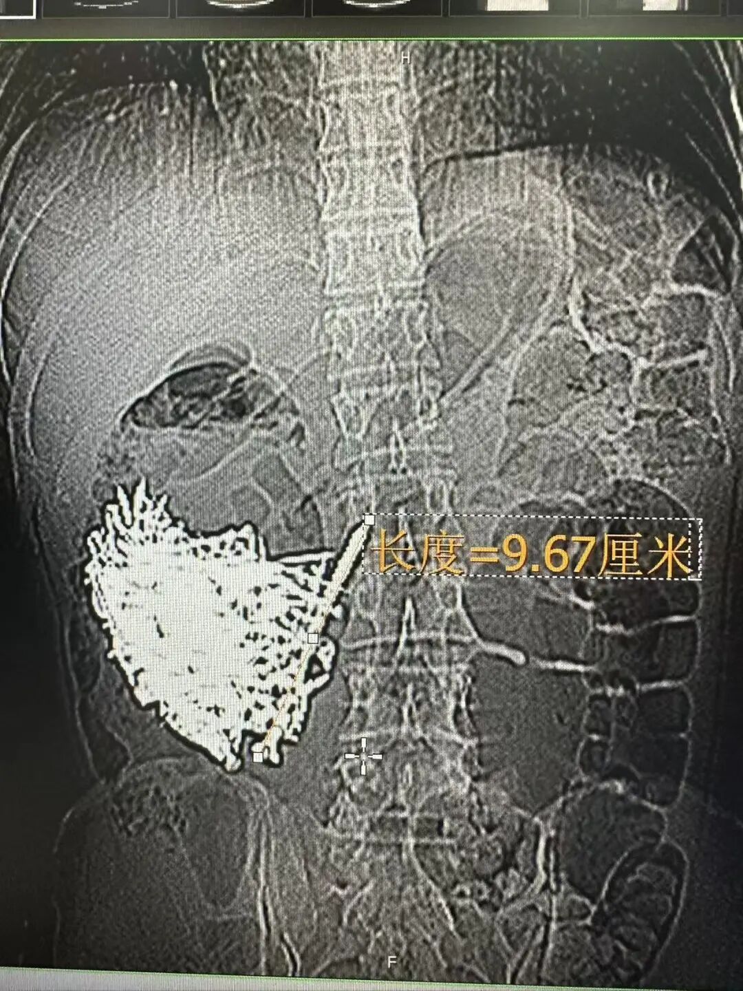 一男子胃中取出180颗铁钉，医生称还有硬币和磁铁等，总重超1公斤，家属回应