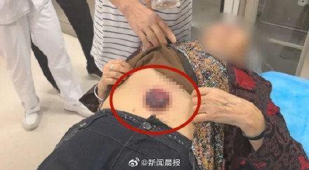 7旬老人用塑料罐拔火罐 无法取下求助消防