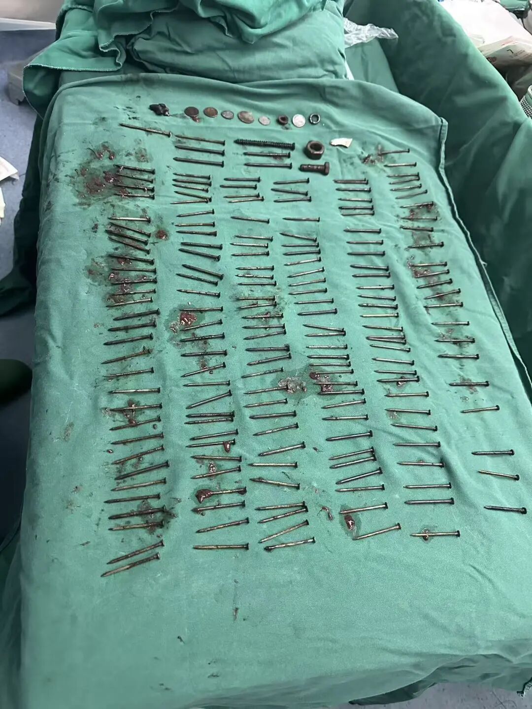 一男子胃中取出180颗铁钉，医生称还有硬币和磁铁等，总重超1公斤，家属回应