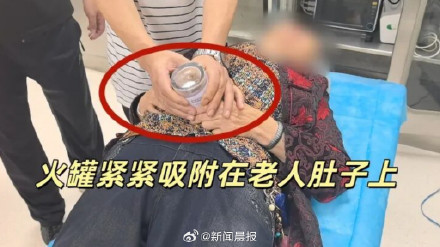 7旬老人用塑料罐拔火罐 无法取下求助消防