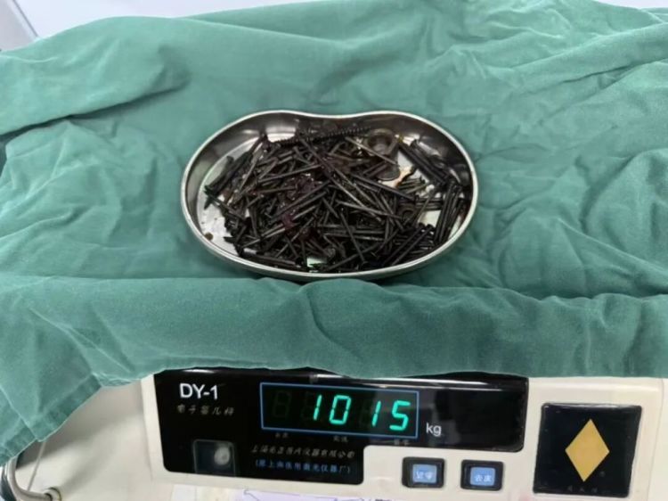 36岁男子胃中取出180颗铁钉：患有精神疾病存在异食行为