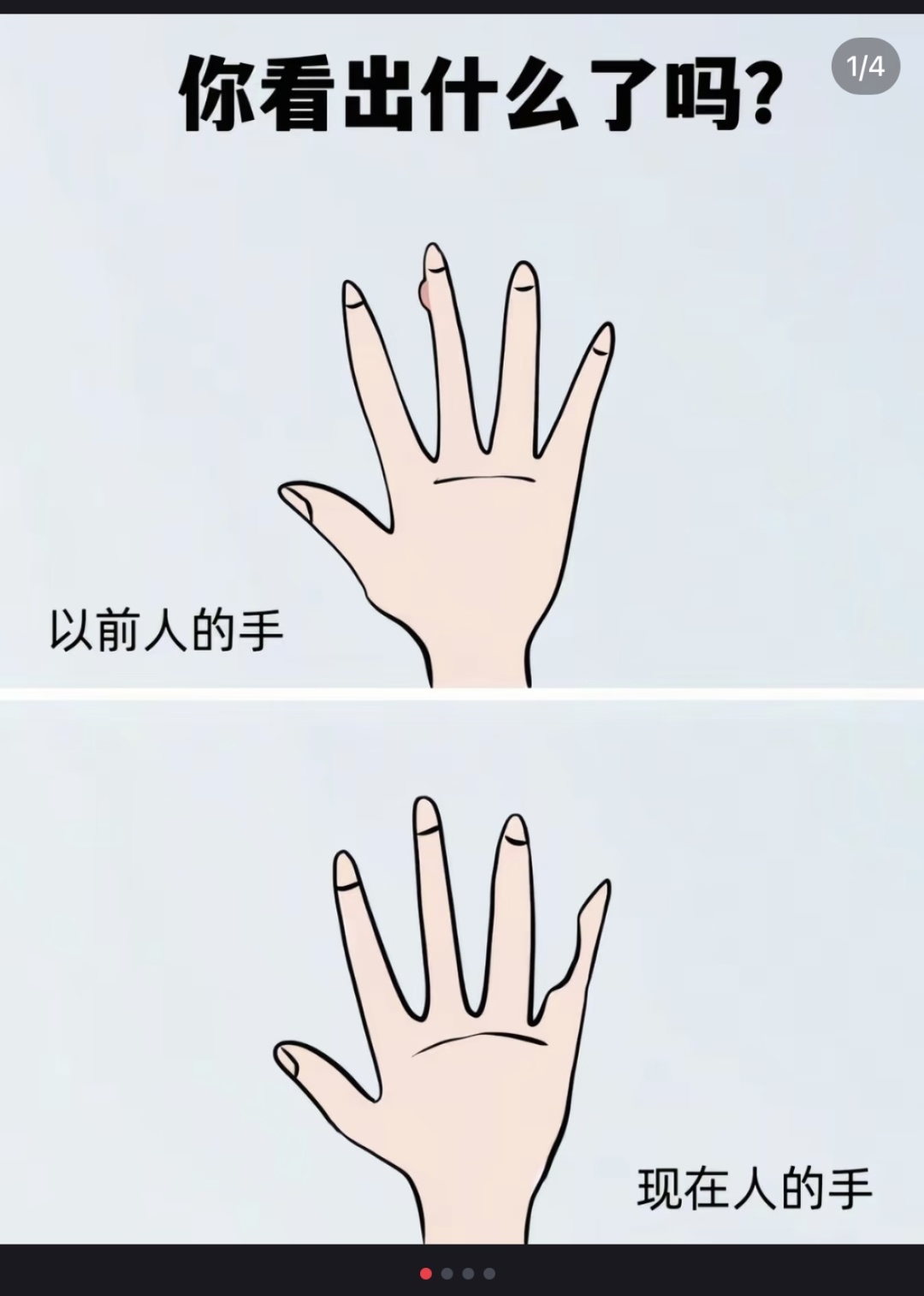 00后女生长期用小拇指托手机导致关节变形，无法握拳！医生提醒……