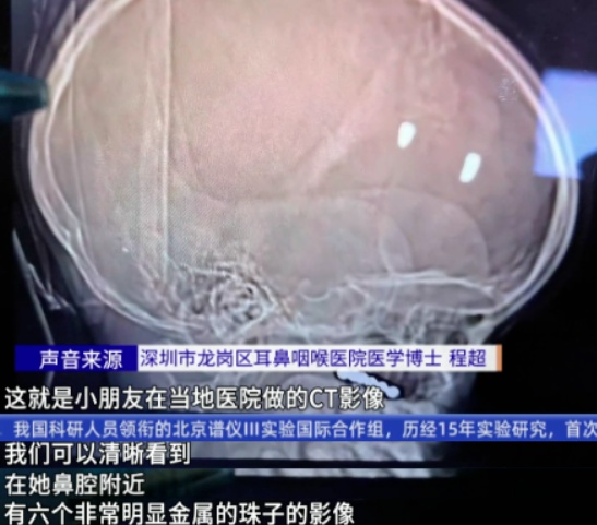 广东6岁孩子做头颅CT,意外发现6颗异物 爸妈脊背发凉:这是2021年买的 广东6岁孩子做头颅CT,意外发现6颗异物 爸妈脊背发凉:这是2021年买的