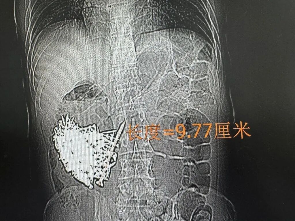 36岁男子反复出现恶心、呕吐9天,胃中取出180颗铁钉,合计重量近1公斤! 36岁男子反复出现恶心、呕吐9天,胃中取出180颗铁钉,合计重量近1公斤!