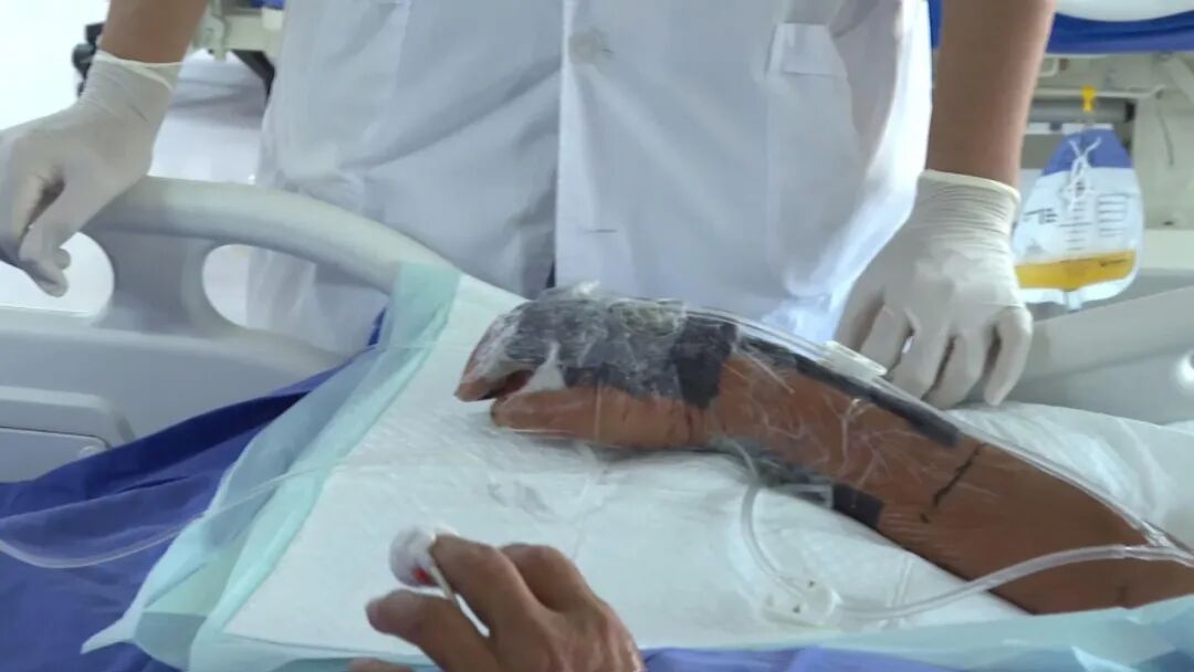 福建一男子被鱼扎伤,送医时血压很低,手指部分已坏死!医生提醒:处理海鲜时最好戴手套 福建一男子被鱼扎伤,送医时血压很低,手指部分已坏死!医生提醒:处理海鲜时最好戴手套