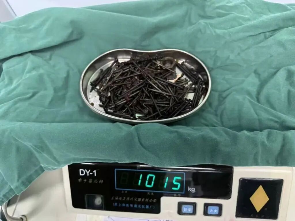 36岁男子反复出现恶心、呕吐9天,胃中取出180颗铁钉,合计重量近1公斤! 36岁男子反复出现恶心、呕吐9天,胃中取出180颗铁钉,合计重量近1公斤!