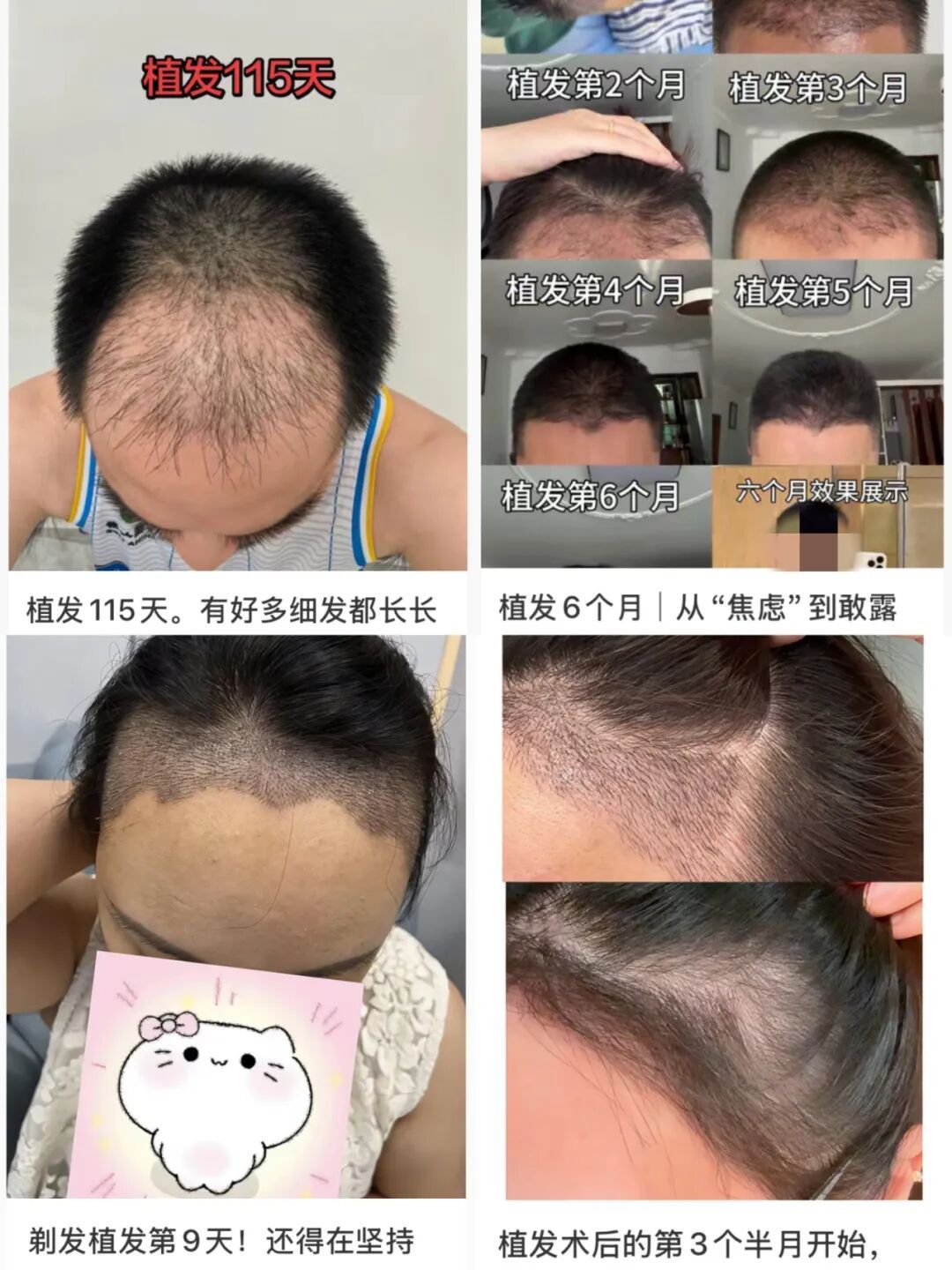 植发并非简单“种头发”！术前必须搞懂的3个关键问题