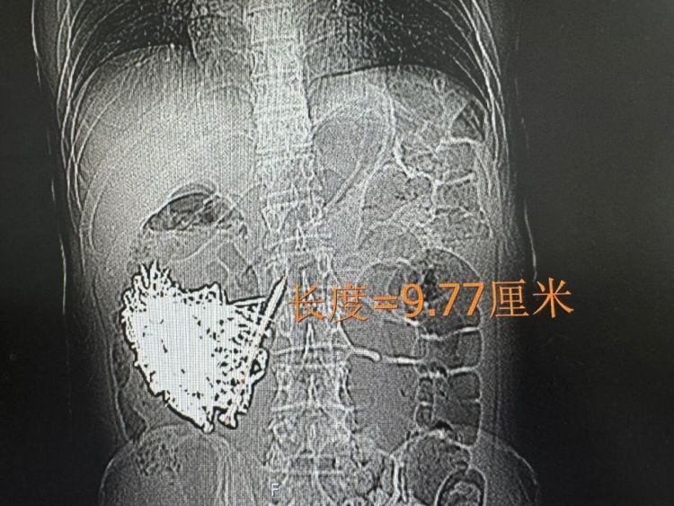 36岁男子胃中取出180颗铁钉：患有精神疾病存在异食行为