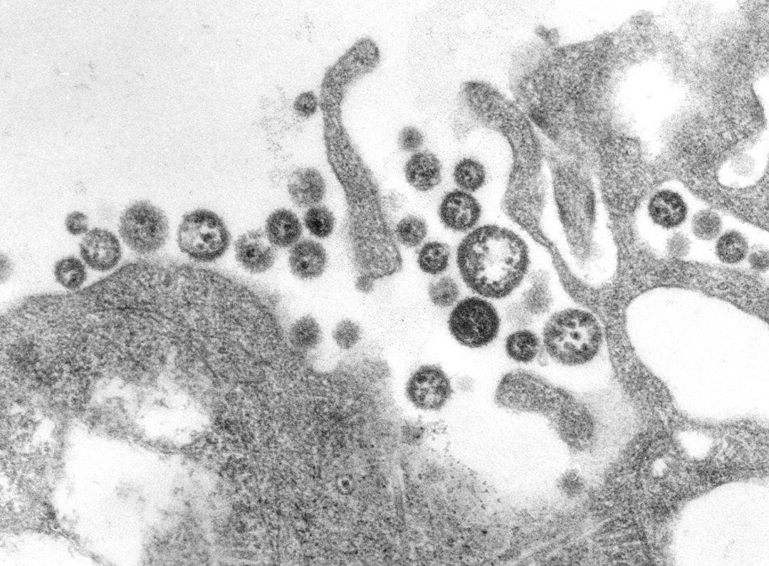尼日利亚今年已报告1000例拉沙热确诊病例，其中237人死亡，病死率达23.7%，较去年同期上升4.9%