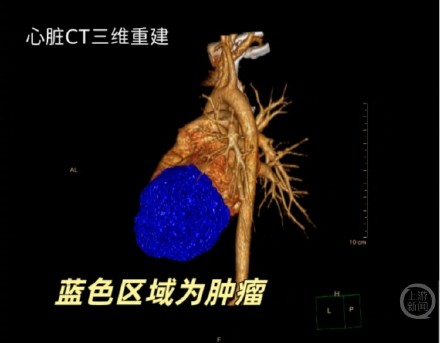 9岁女孩跳皮筋后呼吸不畅 心脏里找到直径达8厘米纤维瘤