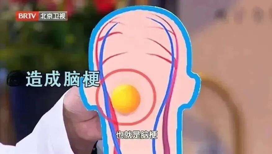 连喝3天绿豆汤,突发脑出血,医生:这4类情况再喜欢也要少碰 连喝3天绿豆汤,突发脑出血,医生:这4类情况再喜欢也要少碰