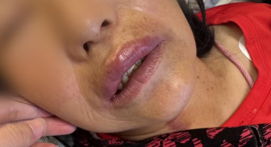 “差点没命!”女子几分钟内浑身发痒,脸肿呼吸困难,医生警告:台风前后是高发期 “差点没命!”女子几分钟内浑身发痒,脸肿呼吸困难,医生警告:台风前后是高发期