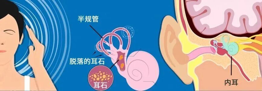 千万别用筋膜枪按这里!有人已经失明、脑梗了,很多人还在天天做 千万别用筋膜枪按这里!有人已经失明、脑梗了,很多人还在天天做