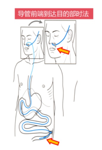 男子3天无法排便，从鼻子插3米管子，排出4升粪水成功疏通……