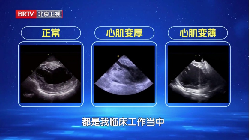 中老年猝死真相:不是心慌,是它悄悄“变形”了,高血压也是帮凶之一 中老年猝死真相:不是心慌,是它悄悄“变形”了,高血压也是帮凶之一