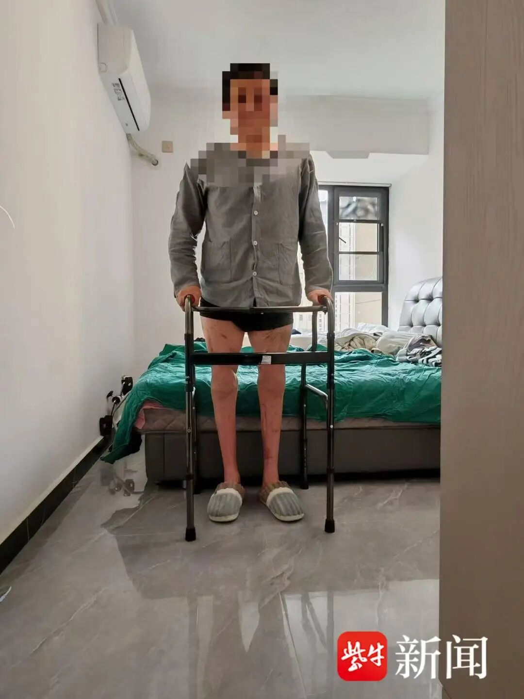 男子双大腿被机器绞断完全分离，经手术重新“接”回，近20个月后已能借助助行器行走